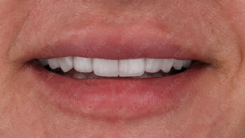 Hollywood Smile Result